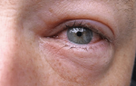 Ожог глаз кварцевой лампой: симптомы и лечение